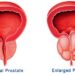 Предпазване на простатата 4